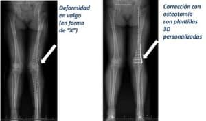 Genu Valgo: Deformidad en 