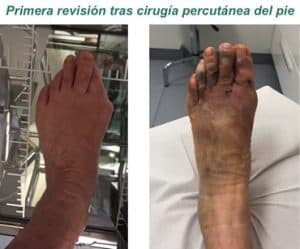 Primera revisión tras cirugía percutánea del pie