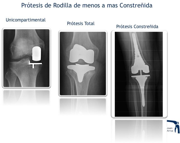 modelos, cirugía artrosis rodilla, prótesis parcial rodilla, nuevo modelo prótesis rodilla, prótesis mínima rodilla, mínima cicatriza, unicompartimental, sustitución rodilla, cambiar rodilla, protesis rodilla, cirujano rodilla, artrosis, dolor rodilla, mejor cirujano rodilla, madrid, artrosis, condromalacia, traumatologo,