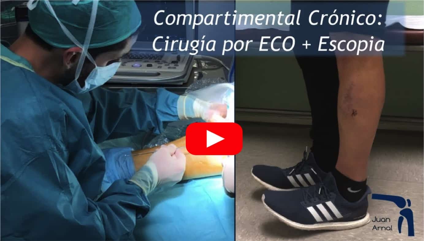 S ndrome Compartimental Cr nico Operaci n Y Tratamiento s-ndrome-compartimental-cr-nico-operaci-n-y-tratamiento