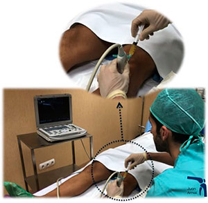 Infiltración PRP en rodilla