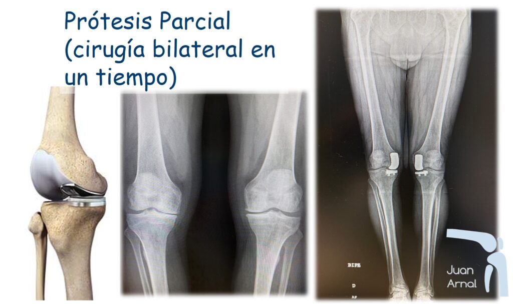 prótesis unicompartimental, parcial, rodilla, juan arnal, cirugía, minimamente invasiva, deporte, protesis, artrosis, cartilago, correr
