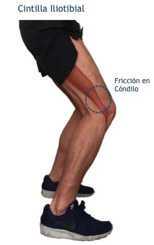 rodilla corredor, juan arnal, cirujano rodilla, cintilla iliotibial, rodilla corredor, dolor correr rodilla, ligamento lateral interno, artrosis rodilla, ligamentos rodilla, cirujano Madrid, privado, traumatologo, madrid, dolor rodilla, condromalacia, dolor rotula, correr, running,