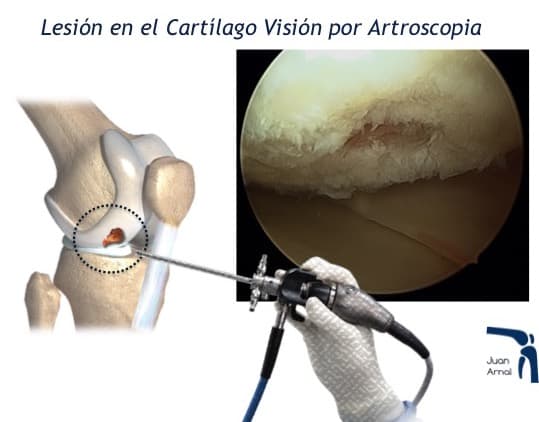 osteocondritis, artroscopia, tratamiento, células madre, rodilla, correr, dolor, lesion cartilago rodilla ulcera osteocondritis