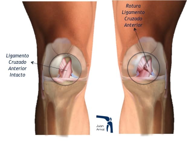 juan arnal, traumatologo, meniscos, rotura menisco, ligamento cruzado anterior, rotura cruzado anterior, ligamento cruzado posterior, plastia cruzado, hth, isquios, semitendinoso, recuperación, cirugía, artroscopia rodilla, tobillo, artrosis rodilla, adeslas, asisa, cirujano rodilla, traumatologo deportivo