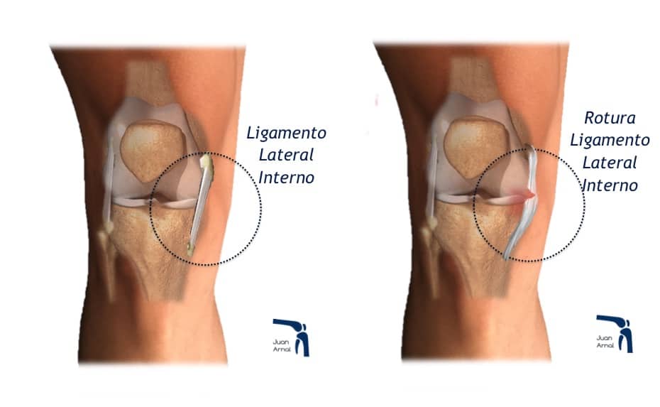 juan arnal, cirujano rodilla, ligamento lateral interno, rotura lateral interno, ligamento medial, esguice lateral interno, esguince rodilla, artrosis rodilla, plastia lateral interno, lesión varios ligamentos rodilla, cirujano Madrid, privado, traumatologo, madrid, dolor rodilla, condromalacia, dolor rotula, correr, running, sentadilla, crossfit, musculación, artrosis de rodilla, genu varo, factores de crecimiento, cirugía, plastia