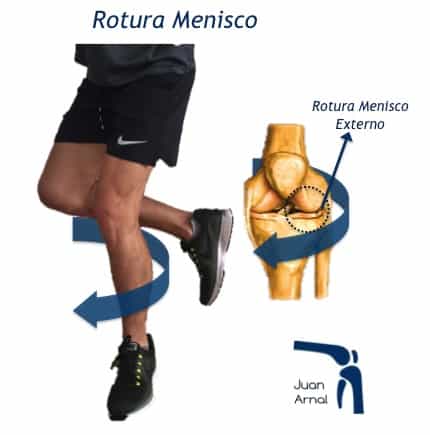 juan arnal, traumatologo, meniscos, rotura menisco, ligamento cruzado anterior, artroscopia rodilla, tobillo, artrosis rodilla, adeslas, asisa, cirujano rodilla, traumatologo deportivo