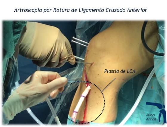 injerto rotuliano, injerto cuadriceps, isquiotibiales, injerto, rotura, cirugia ligamento cruzado anterior, juan arnal, traumatologo, madrid, cirugia, rotura, artroscopia, ligamento cruzado anterior, artroscopia rodilla, sutura menisco, adeslas, asisa, cirujano rodilla, hth, traumatologo deportivo