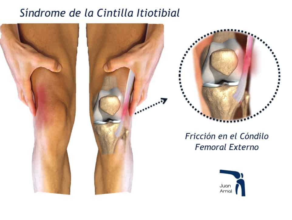 rodilla corredor, juan arnal, cirujano rodilla, cintilla iliotibial, rodilla corredor, dolor correr rodilla, ligamento lateral interno, artrosis rodilla, ligamentos rodilla, cirujano Madrid, privado, traumatologo, madrid, dolor rodilla, condromalacia, dolor rotula, correr, running,