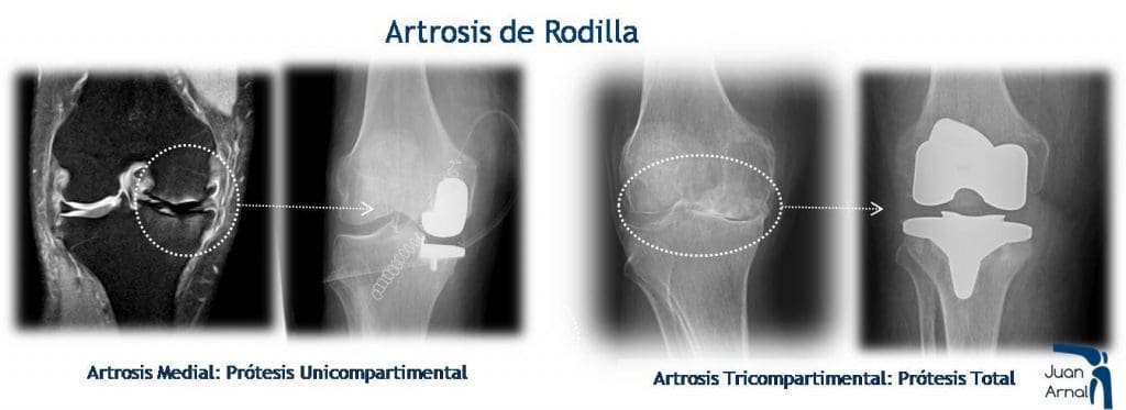 juan arnal, protesis rodilla, cirujano rodilla, artrosis, tipos prótesis rodilla, prótesis parcial rodilla, prótesis unicompartimental, dolor rodilla, mejor cirujano rodilla, madrid, artrosis, condromalacia, traumatologo,