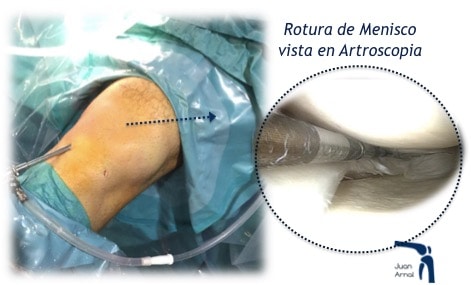 Rotura de menisco vista en artroscopia