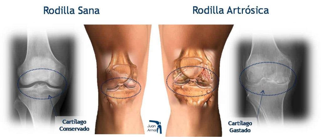 juan arnal, cirujano rodilla, artrosis rodilla, protesis rodilla, cirujano madrid privado, traumatologo, madrid, dolor rodilla, condromalacia