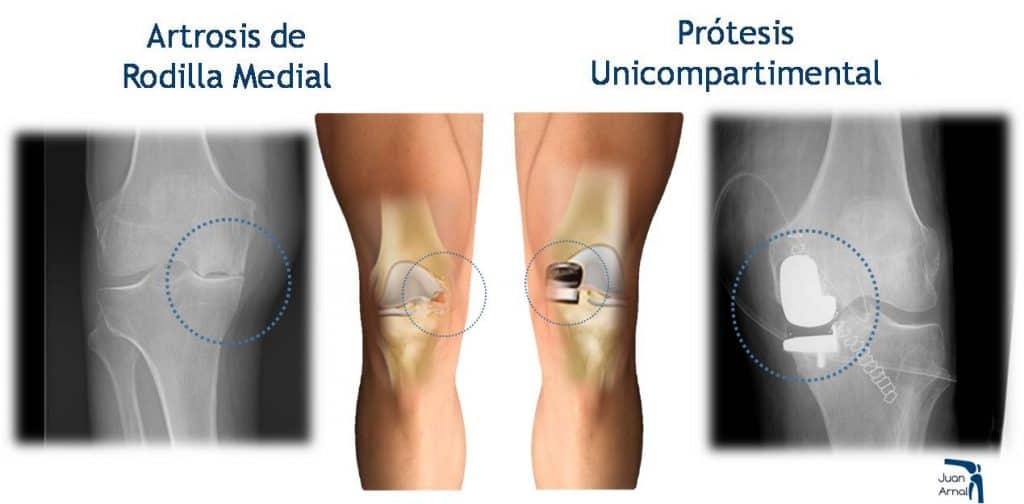 juan arnal, protesis rodilla, cirujano rodilla, artrosis, dolor rodilla, mejor cirujano rodilla, madrid, artrosis, condromalacia, traumatologo,