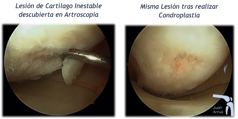 cartílago rodilla suelto, osteocondritis, artroscopia, tratamiento, células madre, rodilla, correr, dolor, lesion cartilago rodilla ulcera osteocondritis