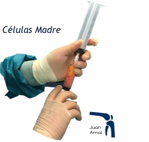 Células madre, mesenquimales, artrosis, regeneración, cartílago, artrosis, rodilla, cadera, prp, factores crecimiento, plasma, plaquetas, células madre, tendón, Aquiles, rotuliano, supraespinoso, tendinitis, epicondilitis, codo tenista, curación, dolor, , terapia biológica, traumatología deportiva, infiltración, ecografía, juan arnal, madrid, deporte, recuperación, rotura muscular, vuelta al deporte, correr, lesion,