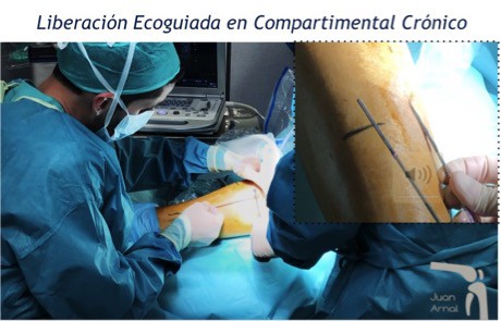 sindrome, corredor, compartimento, muscular, dolor, pierna, correr, ecografía, mis, ultra, mínimamente, invasiva, intervención, sin incisiones, juan arnal, traumatologo, madrid, cirugia ecoguiada, mis, exploración, medición, presión, fútbol, running, dolor, fisioterapia, tibial anterior, periostitis,