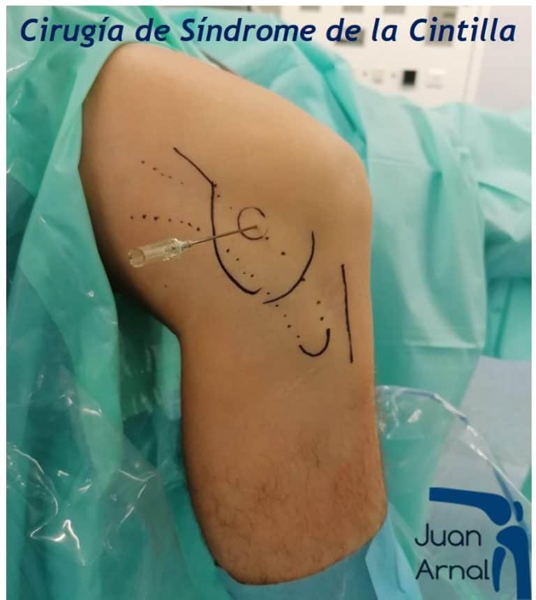 rodilla corredor, juan arnal, cirujano rodilla, cintilla iliotibial, rodilla corredor, dolor correr rodilla, ligamento lateral interno, artrosis rodilla, ligamentos rodilla, cirujano Madrid, privado, traumatologo, madrid, dolor rodilla, condromalacia, dolor rotula, correr, running,