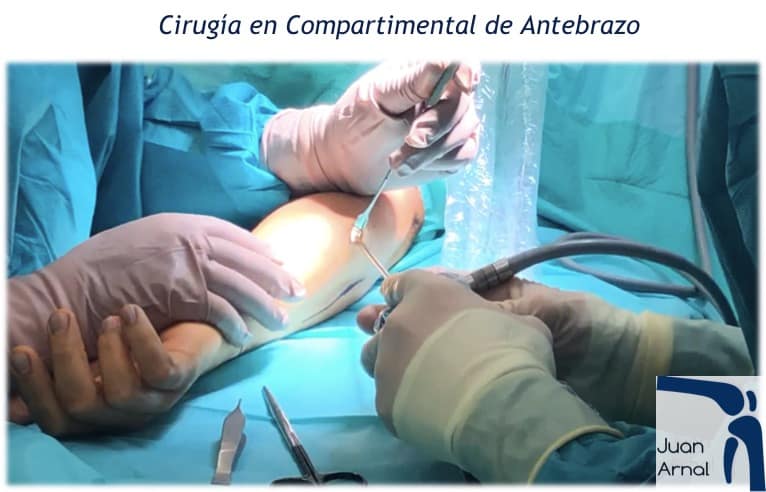 compartimental, sindrome, antebrazo, pierna, correr, moto, enduro, remo, motocross, músculos, dolor muscular, presión, traumatología, cirugía, recuperación, juan arnal, traumatología, deportivo, madrid, mejor, adeslas,