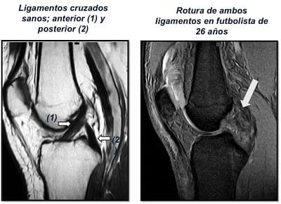 juan arnal, traumatologo, meniscos, rotura menisco, ligamento cruzado anterior, rotura cruzado anterior, ligamento cruzado posterior, plastia cruzado, hth, isquios, semitendinoso, recuperación, cirugía, artroscopia rodilla, tobillo, artrosis rodilla, adeslas, asisa, cirujano rodilla, traumatologo deportivo