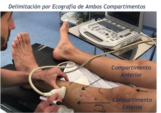 sindrome, corredor, compartimento, muscular, dolor, pierna, correr, ecografía, mis, ultra, mínimamente, invasiva, intervención, sin incisiones, juan arnal, traumatologo, madrid, cirugia ecoguiada, mis, exploración, medición, presión, fútbol, running, dolor, fisioterapia, tibial anterior, periostitis,