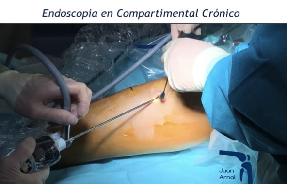 sindrome, corredor, compartimento, muscular, dolor, pierna, correr, ecografía, mis, ultra, mínimamente, invasiva, intervención, sin incisiones, juan arnal, traumatologo, madrid, cirugia ecoguiada, mis, exploración, medición, presión, fútbol, running, dolor, fisioterapia, tibial anterior, periostitis,