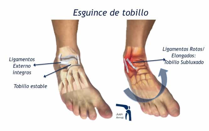 inestabilidad tobillo, dolor tobillo, tobillo fútbol, juan arnal, truamtologo madrid