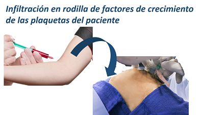 juan arnal, cirujano rodilla, artrosis rodilla, protesis rodilla, cirujano madrid privado, traumatologo, madrid, dolor rodilla, condromalacia, artrosis de rodilla, genu varo, factores de crecimiento, tratamiento artrosis,