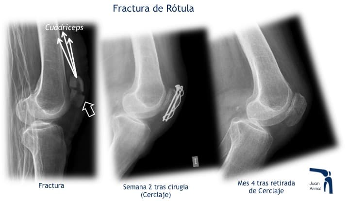 juan arnal, traumatologo, madrid, rotura, fractura, cirugia, deporte, recuperacion, operacion,