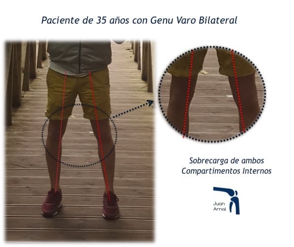 juan arnal, traumatologo, dolor rodilla, piernas desviadas, piernas en c, piernas en circula, rodillas circulares, genu varo, osteotomía tibia, corrección piernas, piernas torcidas, cirugía, adeslas, asisa, cirujano rodilla, traumatologo deportivo