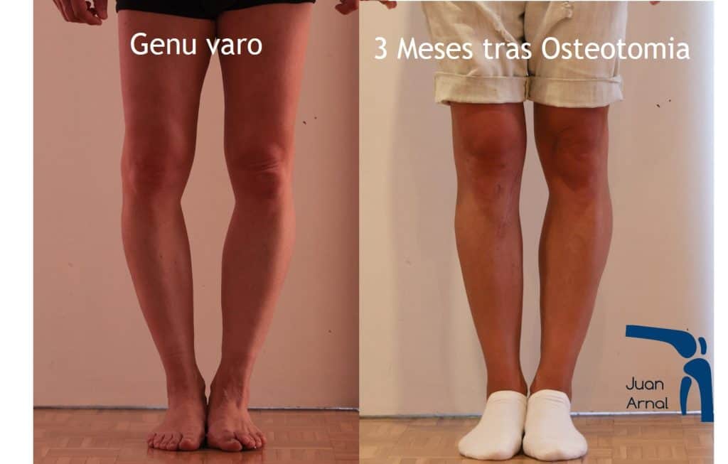 genu varo, osteotomia, rodillas arqueadas, en c, tibial, alta, apertura, deformidad, corrección, cirugía, rectas, piernas, varo rodilla, pierna vara