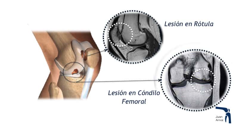 osteocondritis, artroscopia, tratamiento, células madre, rodilla, correr, dolor, lesion cartilago rodilla ulcera osteocondritis