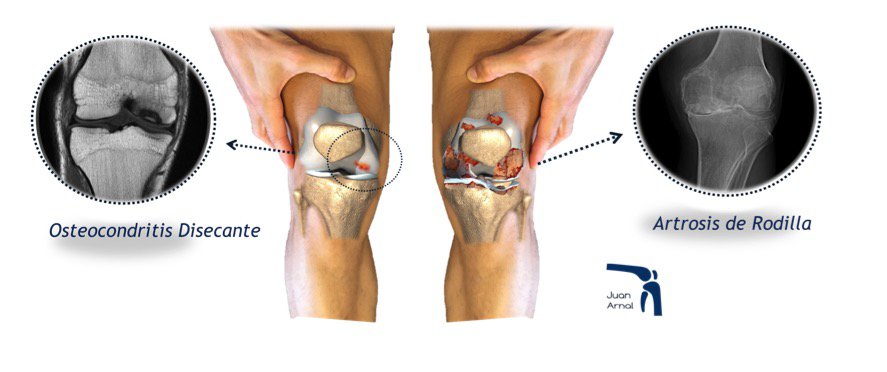 rodilla, úlcera de cartílago, osteocondritis, condropatías, lesión cartílago rodilla, condilo, cartílago, artrosis de rodilla, rotura cartílago, cartílago suelto, rodilla, madrid, juan arnal, traumatologo, rotura cruzado, cirujano rodilla, madrid, mejor, tratamiento, sin prótesis, prótesis de rodilla