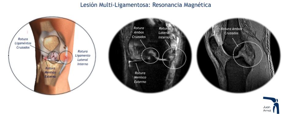 resonancia magnetica,juan arnal, cirujano rodilla, rotura multiples ligamentos, luxación rodilla, rotura cruzado anterior, rotura cruzado posterior, ligamento lateral interno, rotura lateral interno, ligamento medial, esguice lateral interno, esguince rodilla, artrosis rodilla, plastia lateral interno, lesión varios ligamentos rodilla, cirujano Madrid, privado, traumatologo, madrid, dolor rodilla, condromalacia, dolor rotula, correr, running, sentadilla, crossfit, musculación, artrosis de rodilla, genu varo, factores de crecimiento, cirugía, plastia