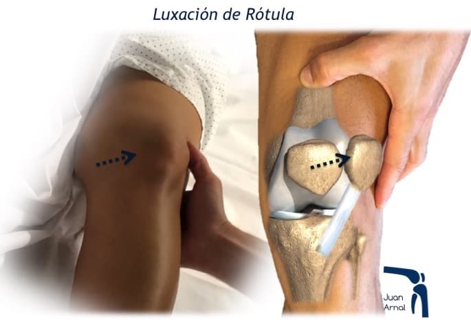 luxación de rotula, inestabilidad de rotula, crónica, luxación, rodilla, salirse la rotula, cirugía, madrid, traumatologo, cirujano, españa, mejor, juan arnal, ligamento patéelo femoral medial, tta, tuberosidad tibial, tendón rotuliano, distalización, plastia, reconstrucción, distancia, ta gt, rotula alta, rotura ligamento, causas, tratamiento, operar, operación, maquet, fulkerson, osteotomia, distalizacion, aparato extensor, medializacion, angulo q,