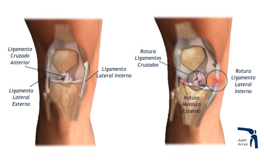 juan arnal, cirujano rodilla, rotura multiples ligamentos, luxación rodilla, rotura cruzado anterior, rotura cruzado posterior, ligamento lateral interno, rotura lateral interno, ligamento medial, esguice lateral interno, esguince rodilla, artrosis rodilla, plastia lateral interno, lesión varios ligamentos rodilla, cirujano Madrid, privado, traumatologo, madrid, dolor rodilla, condromalacia, dolor rotula, correr, running, sentadilla, crossfit, musculación, artrosis de rodilla, genu varo, factores de crecimiento, cirugía, plastia