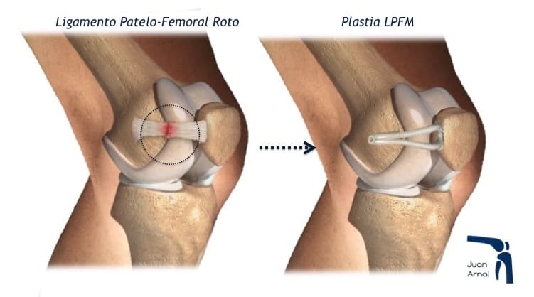 rotula alta, luxación de rotula, inestabilidad de rotula, crónica, luxación, rodilla, salirse la rotula, cirugía, madrid, traumatologo, cirujano, españa, mejor, juan arnal, ligamento patéelo femoral medial, tta, tuberosidad tibial, tendón rotuliano, distalización, plastia, reconstrucción, distancia, ta gt, rotula alta, rotura ligamento, causas, tratamiento, operar, operación, maquet, fulkerson, osteotomia, distalizacion, aparato extensor, medializacion, angulo q,