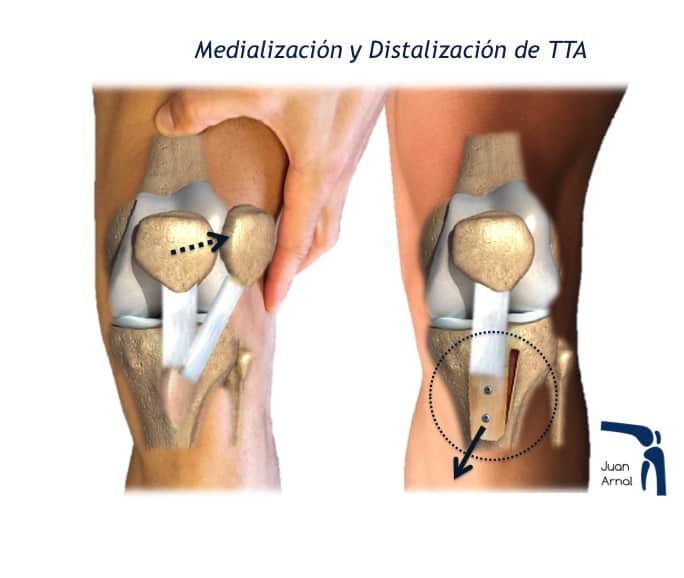 medializacion, distalizacion, tta, tuberosidad tibial, realineacion, aparato extensor, rotula alta, luxación de rotula, inestabilidad de rotula, crónica, luxación, rodilla, salirse la rotula, cirugía, madrid, traumatologo, cirujano, españa, mejor, juan arnal, ligamento patéelo femoral medial, tta, tuberosidad tibial, tendón rotuliano, distalización, plastia, reconstrucción, distancia, ta gt, rotula alta, rotura ligamento, causas, tratamiento, operar, operación, maquet, fulkerson, osteotomia, distalizacion, aparato extensor, medializacion, angulo q,