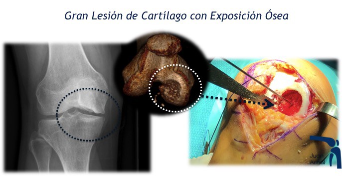 mega transplante, transplante rodilla, mega oats, cartilago transplante rodilla