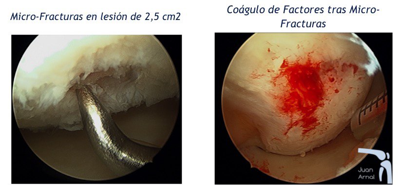 pridie, perforaciones, cartílago rodilla suelto, osteocondritis, artroscopia, tratamiento, células madre, rodilla, correr, dolor, lesion cartilago rodilla ulcera osteocondritis