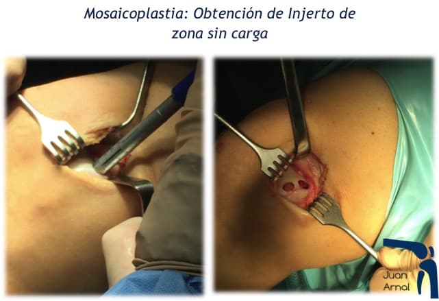 mosaicoplastia transplante cartilago rodilla lesion