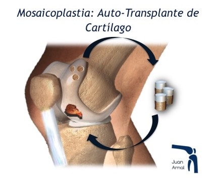 mosaicoplastia, lesion grado 4, cartílago rodilla suelto, osteocondritis, artroscopia, tratamiento, células madre, rodilla, correr, dolor, lesion cartilago rodilla ulcera osteocondritis