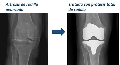 juan arnal, cirujano rodilla, artrosis rodilla, protesis rodilla, cirujano madrid privado, traumatologo, madrid, dolor rodilla, condromalacia, artrosis de rodilla, genu varo, factores de crecimiento, tratamiento artrosis,