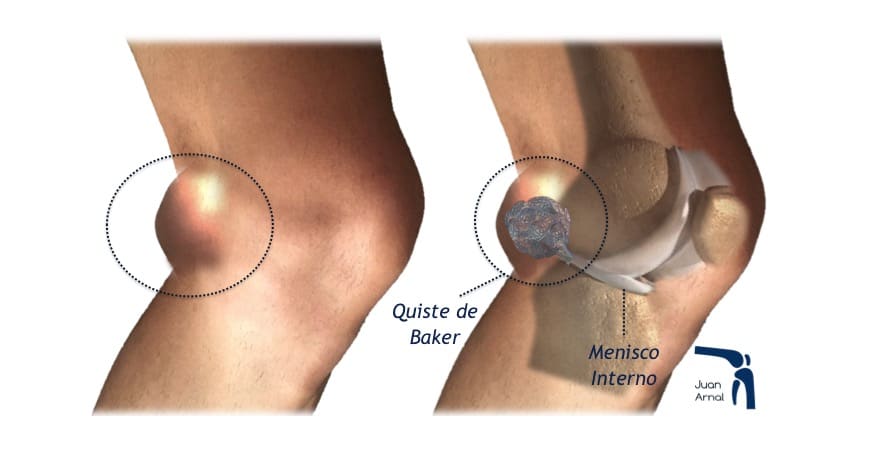 juan arnal, traumatologo, quiste Baker, bulto rodilla, bulto corva, artrosis, quiste poplíteo, dolor rodilla, drenaje, rotura menisco, quiste menisco, cirugía, adeslas, asisa, cirujano rodilla, traumatologo deportivo