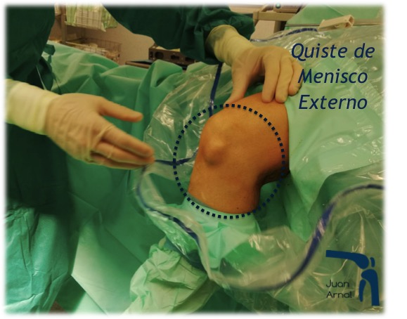 quiste de menisco, bulto rodilla, dolor, juan arnal, traumatologo, meniscos, rotura menisco, ligamento cruzado anterior, artroscopia rodilla, tobillo, artrosis rodilla, adeslas, asisa, cirujano rodilla, traumatologo deportivo