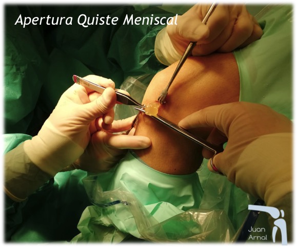 uiste menisco, menisco roto, bulto rodilla, juan arnal, traumatologo, meniscos, rotura menisco, ligamento cruzado anterior, artroscopia rodilla, tobillo, artrosis rodilla, adeslas, asisa, cirujano rodilla, traumatologo deportivo