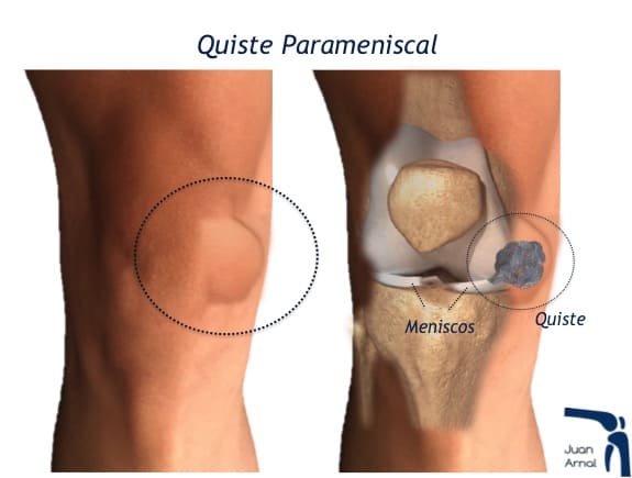 juan arnal, traumatologo, meniscos, rotura menisco, ligamento cruzado anterior, artroscopia rodilla, tobillo, artrosis rodilla, adeslas, asisa, cirujano rodilla, traumatologo deportivo