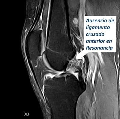 Afortunadamente lo mas frecuente durante la práctica deportiva es la rotura del cruzado anterior aislada, o con una rotura de menisco asociada.