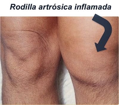 juan arnal, cirujano rodilla, artrosis rodilla, protesis rodilla, cirujano madrid privado, traumatologo, madrid, dolor rodilla, condromalacia, artrosis de rodilla, genu varo, factores de crecimiento, tratamiento artrosis,