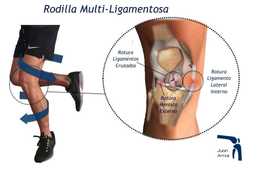 juan arnal, cirujano rodilla, rotura multiples ligamentos, luxación rodilla, rotura cruzado anterior, rotura cruzado posterior, ligamento lateral interno, rotura lateral interno, ligamento medial, esguice lateral interno, esguince rodilla, artrosis rodilla, plastia lateral interno, lesión varios ligamentos rodilla, cirujano Madrid, privado, traumatologo, madrid, dolor rodilla, condromalacia, dolor rotula, correr, running, sentadilla, crossfit, musculación, artrosis de rodilla, genu varo, factores de crecimiento, cirugía, plastia
