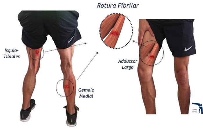 Rotura muscular, rotura fibras, rotura gemelo, rotura de isquios, rotura semitendinoso, rotura adductor, correr, fútbol, fondo, mediofondo, velocidad, pedrada muscular, hematoma musculo, ecografía, juan arnal, traumatologo, , artrosis rodilla, adeslas, asisa, cirujano rodilla, traumatologo deportivo